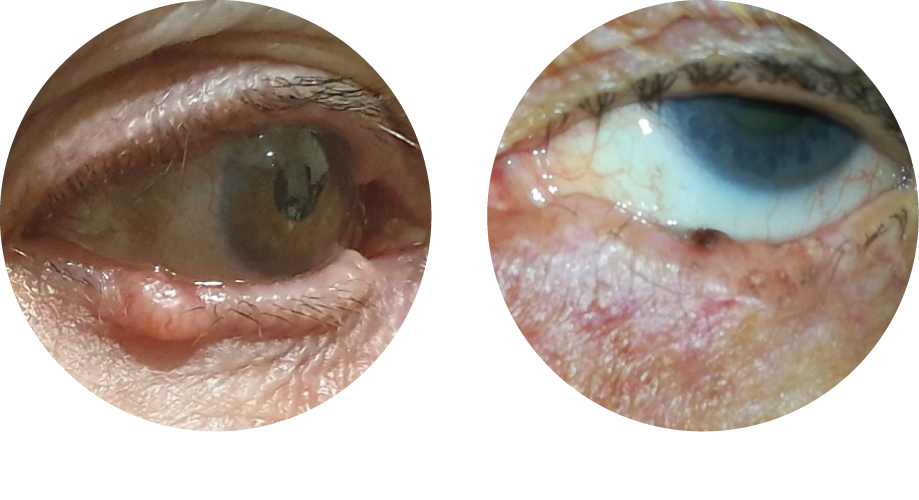 Clinical forms of basal cell carcinoma