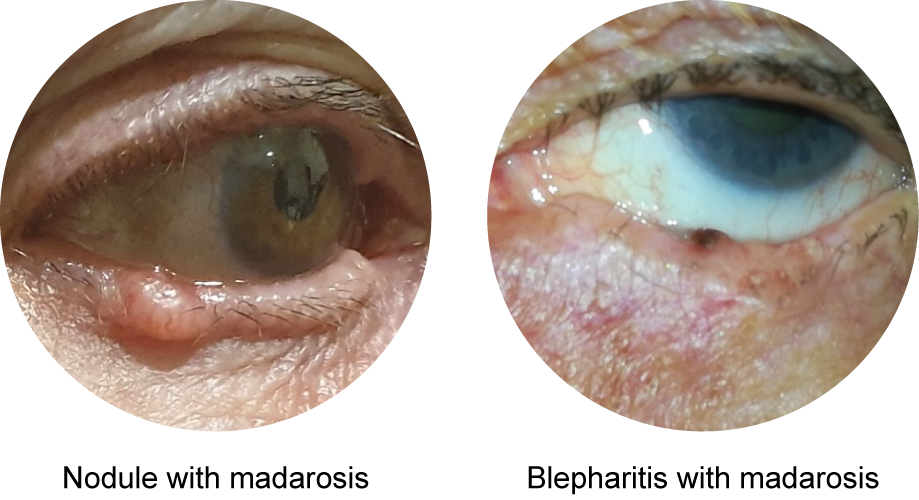 Clinical forms of basal cell carcinoma