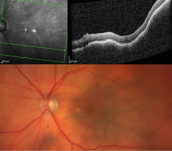 Imagerie d'un lymphome choroïdien