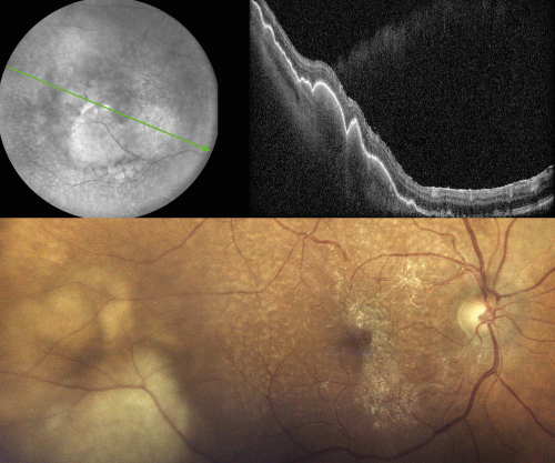 Imagerie d'un lymphome vitréo-rétinien