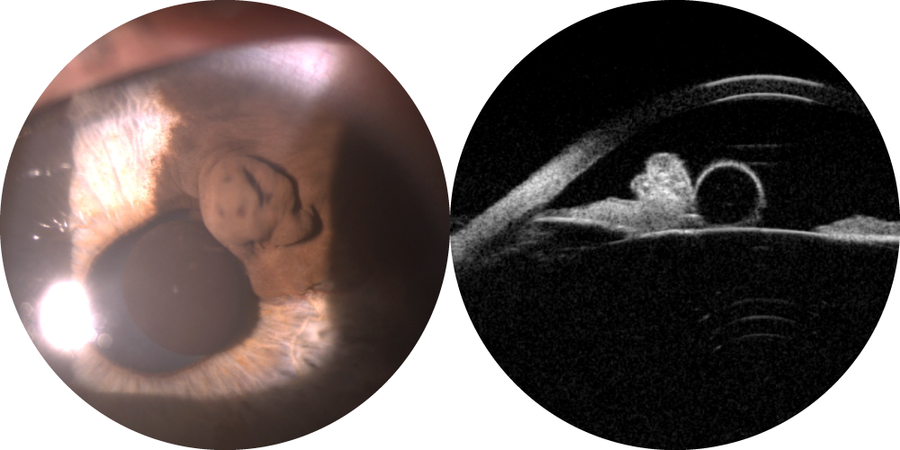 Photographie et échographie de mélanome irien