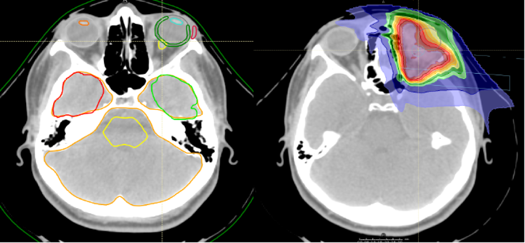 Plan de protonthérapie