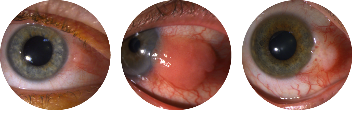 Clinical presentations of carcinomas and dysplasias