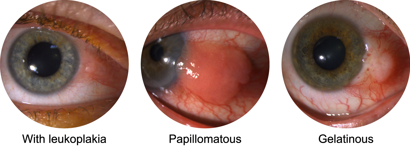 Clinical presentations of carcinomas and dysplasias