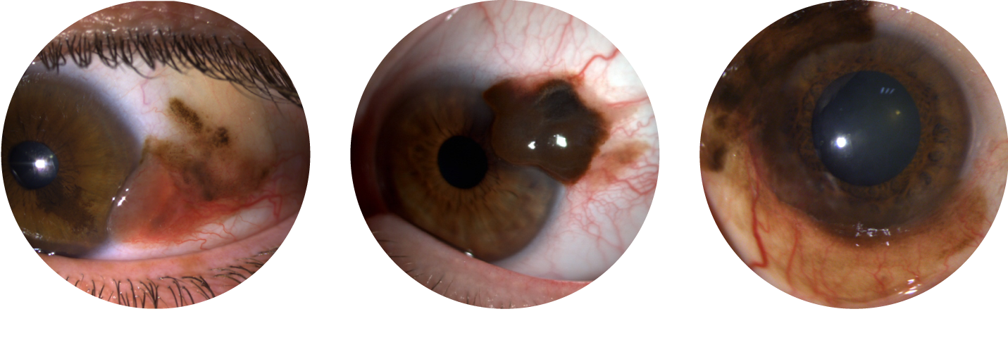 Conjunctival melanoma depending on origin