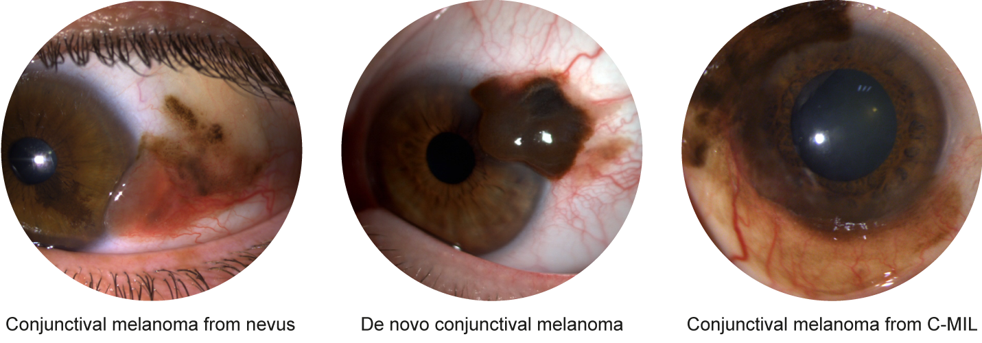 Conjunctival melanoma depending on origin