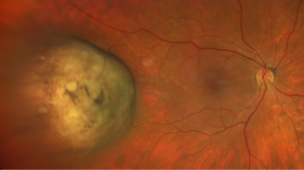 Tumeurs à l’intérieur de l’œil