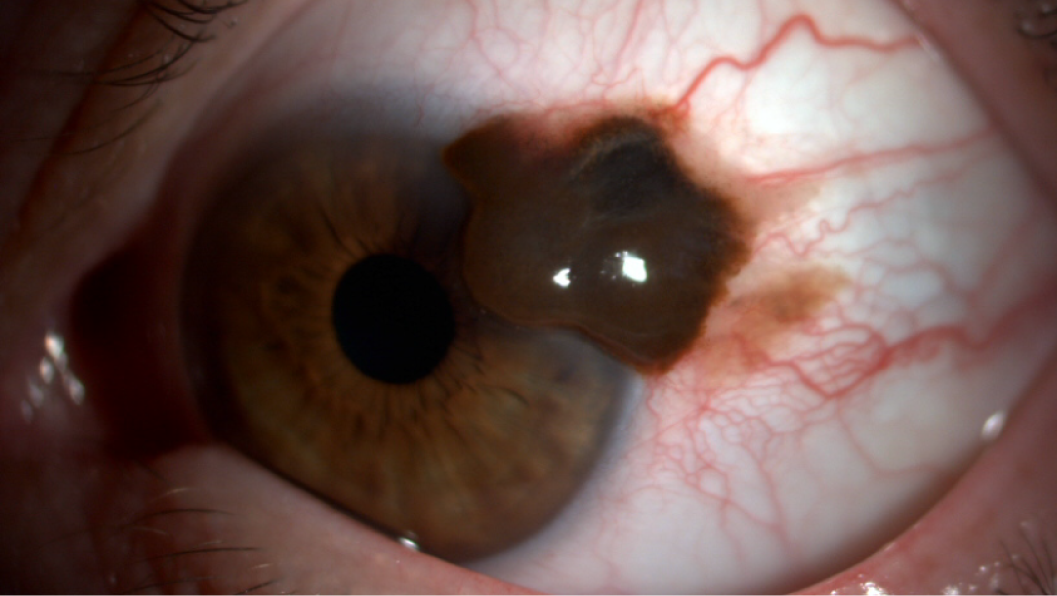 Mélanome conjonctival