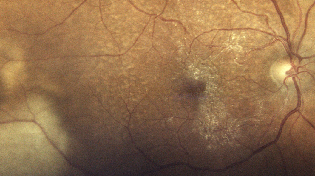 Lymphome intraoculaire