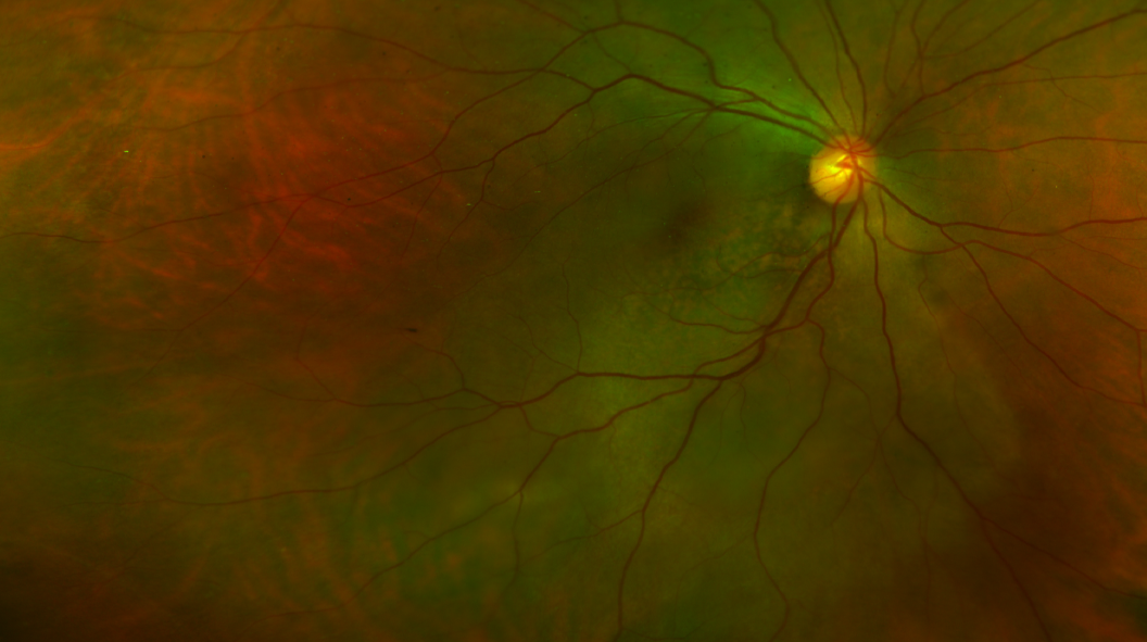 Métastases uvéales