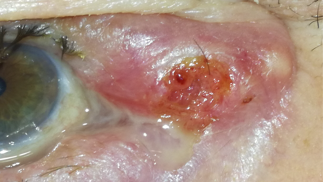 Carcinome épidermoïde