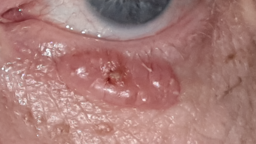 Carcinome basocellulaire